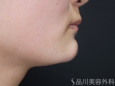 症例NO.70008のAFTER写真