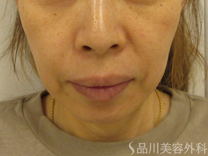 症例NO.74695のBEFORE写真