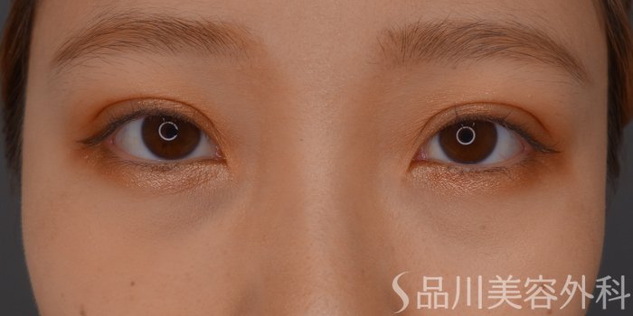 症例NO.74411のAFTER写真