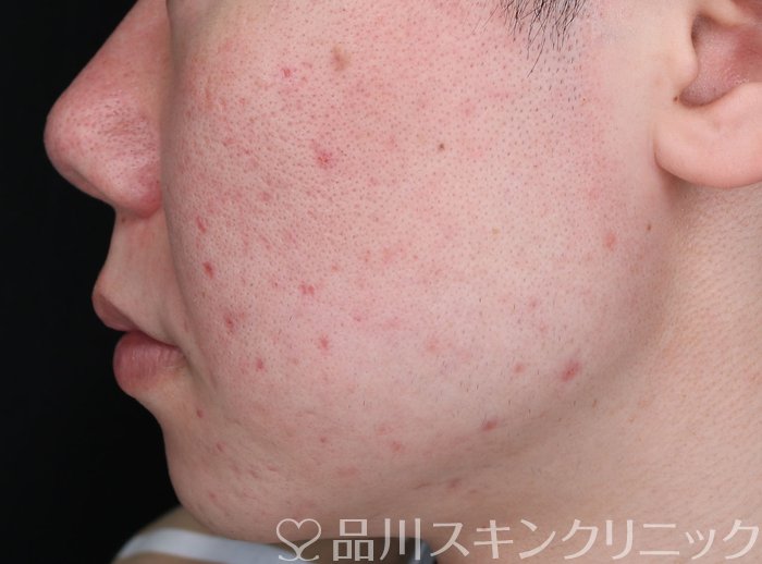 症例NO.73960のBEFORE写真