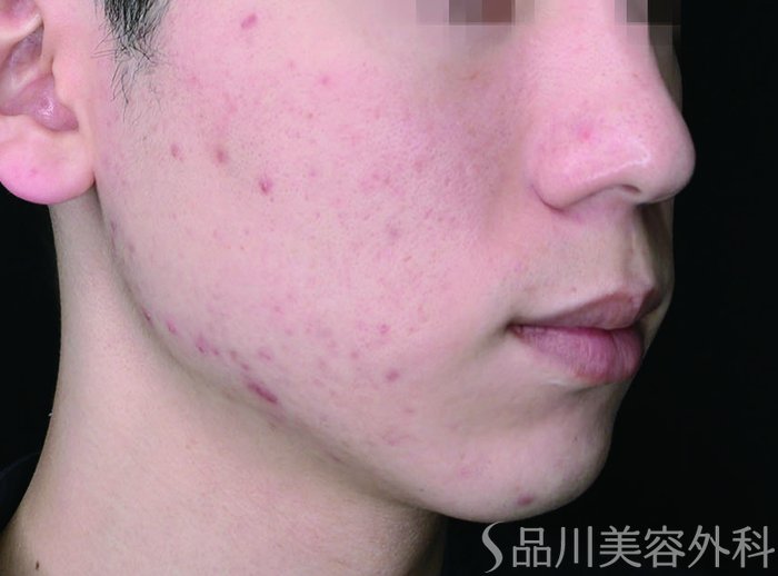 症例NO.74843のBEFORE写真