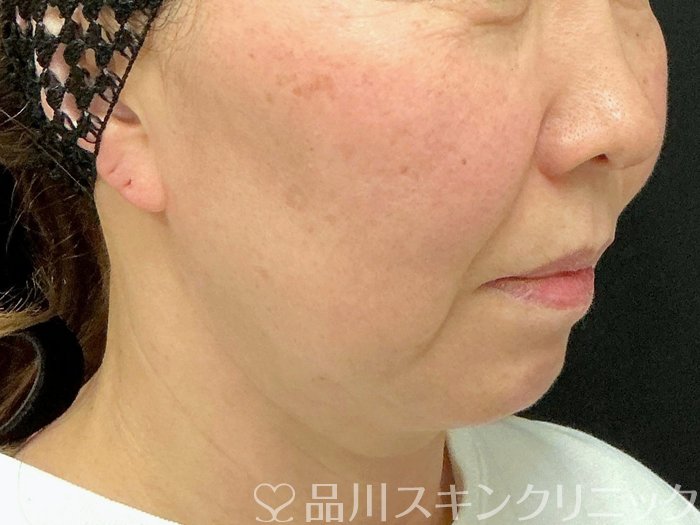 症例NO.74938のBEFORE写真