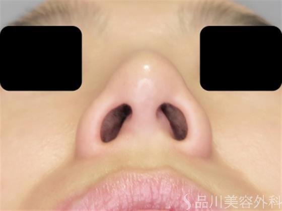 症例NO.49491のAFTER写真