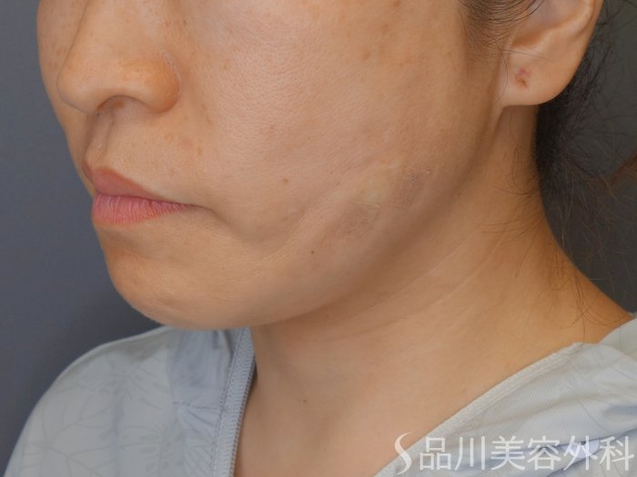 症例NO.71087のAFTER写真