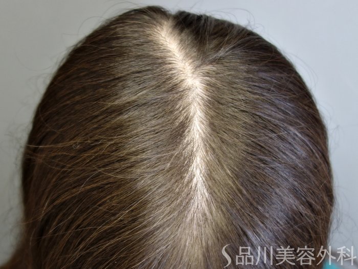 症例NO.73856のBEFORE写真