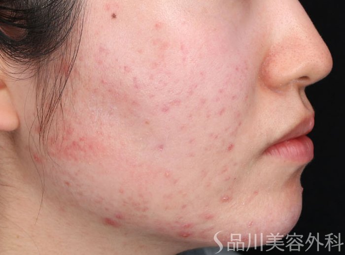 症例NO.72876のBEFORE写真