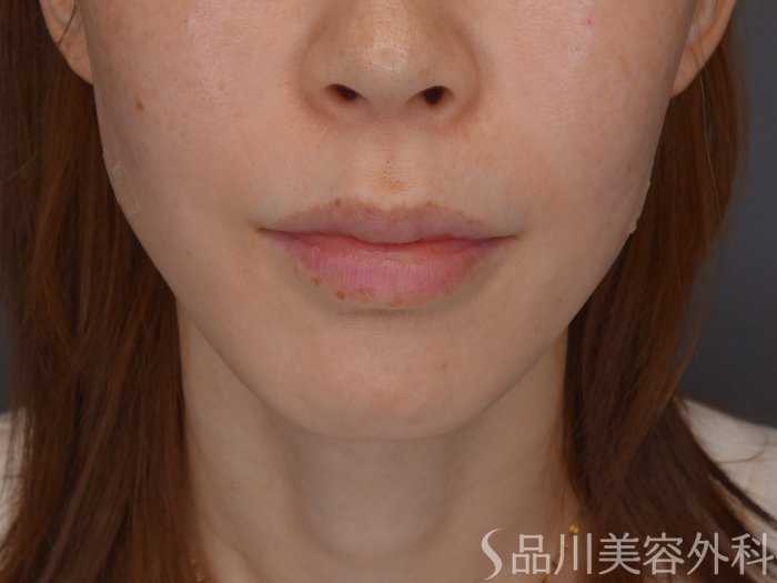 症例NO.72390のAFTER写真