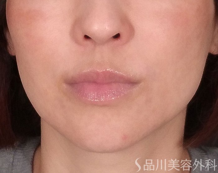 症例NO.69993のBEFORE写真