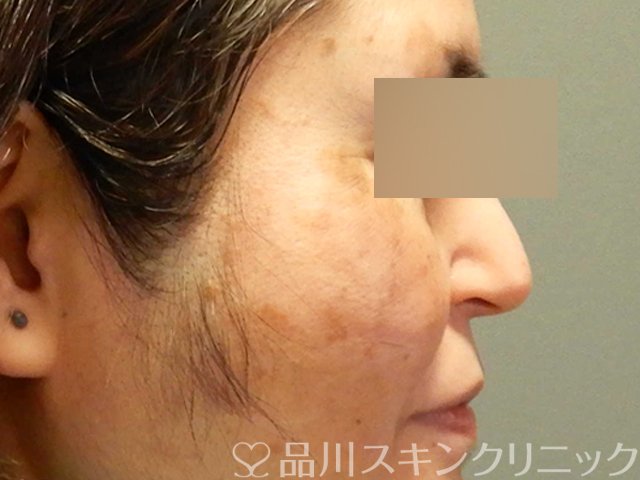 症例NO.69180のBEFORE写真