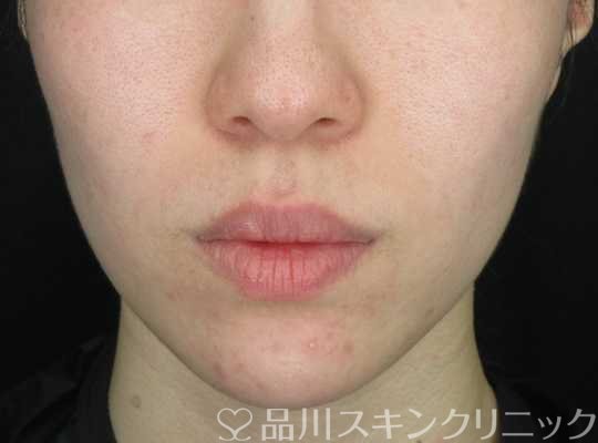 症例NO.67630のAFTER写真