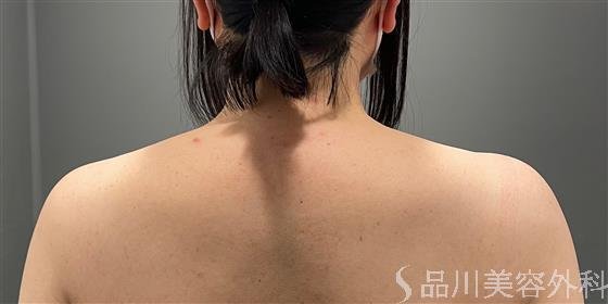 症例NO.51113のBEFORE写真