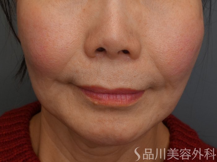症例NO.73952のBEFORE写真