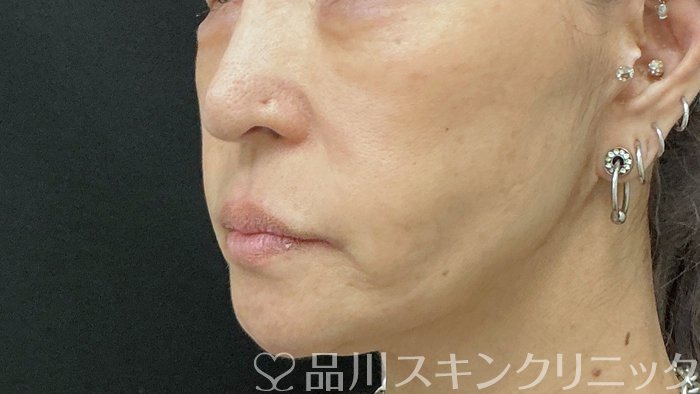 症例NO.74504のBEFORE写真