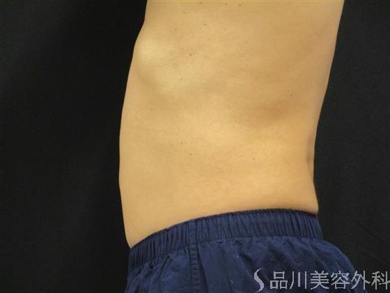 症例NO.50910のAFTER写真