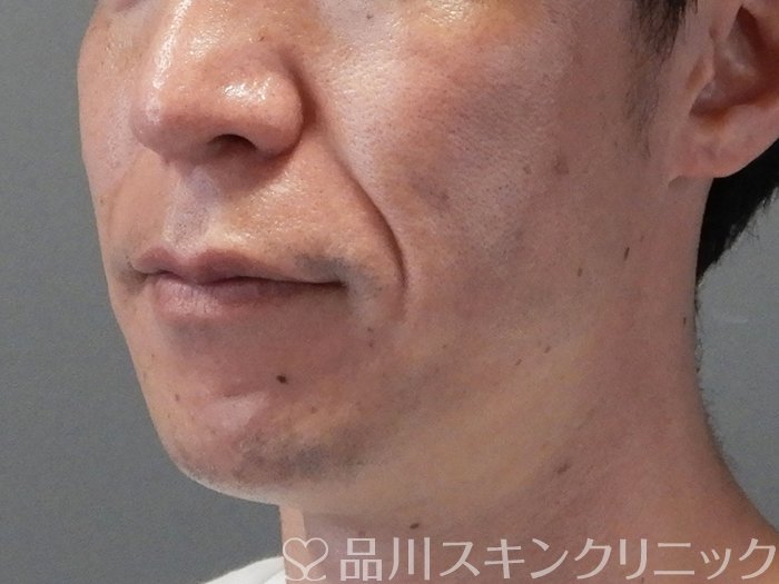 症例NO.70689のBEFORE写真
