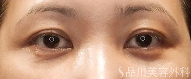 症例NO.72121のAFTER写真