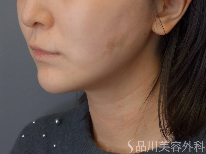 症例NO.72913のAFTER写真