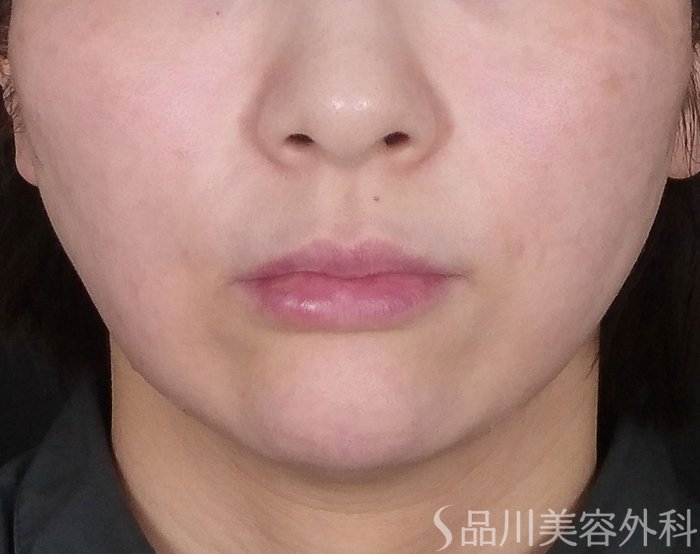 症例NO.67698のAFTER写真