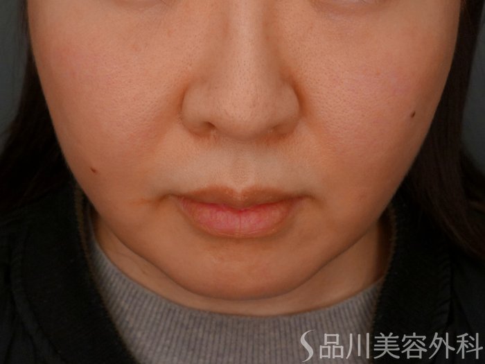 症例NO.73744のAFTER写真