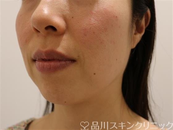 症例NO.44662のBEFORE写真