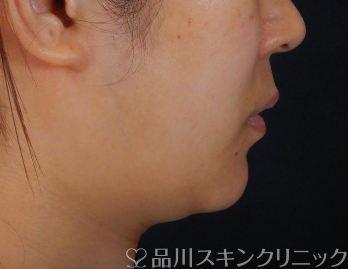 症例NO.65842のBEFORE写真