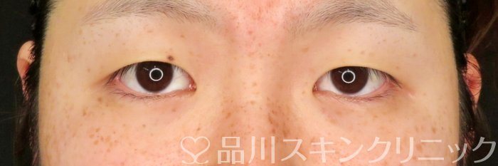 症例NO.74143のBEFORE写真