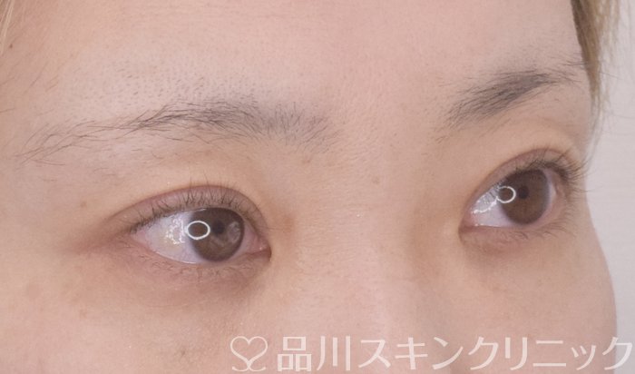 症例NO.64812のAFTER写真