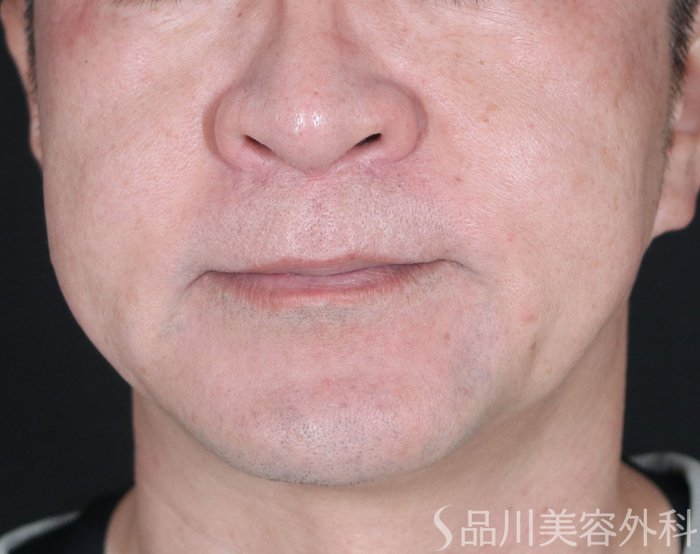 症例NO.72565のBEFORE写真