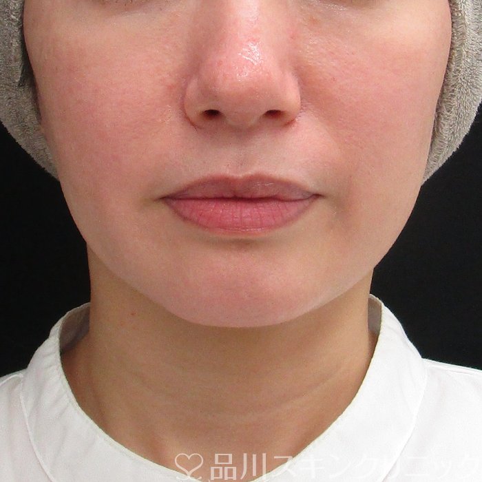 症例NO.69926のBEFORE写真