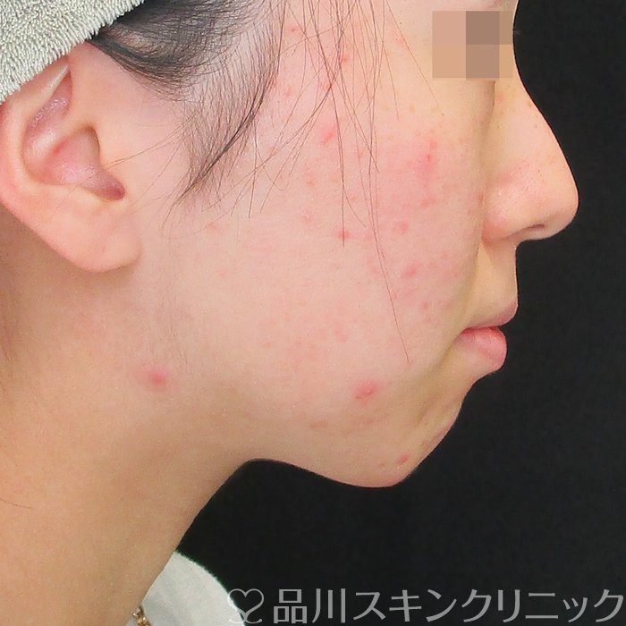 症例NO.74179のBEFORE写真