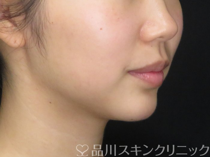 症例NO.62345のAFTER写真