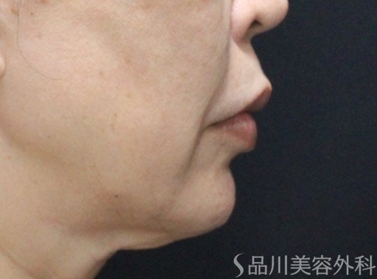 症例NO.74958のBEFORE写真