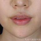 症例NO.74365のAFTER写真