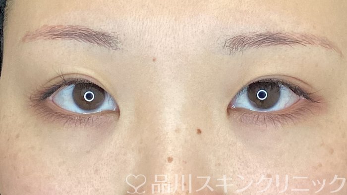 症例NO.75394のBEFORE写真