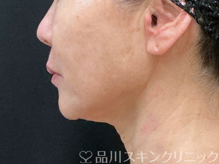 症例NO.74403のBEFORE写真