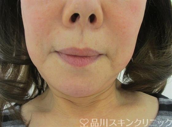症例NO.33028のBEFORE写真