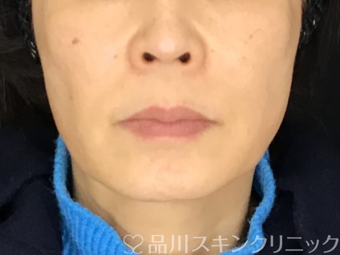 症例NO.69593のBEFORE写真