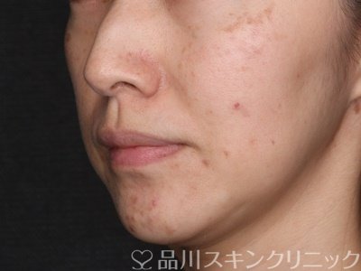 症例NO.71653のBEFORE写真
