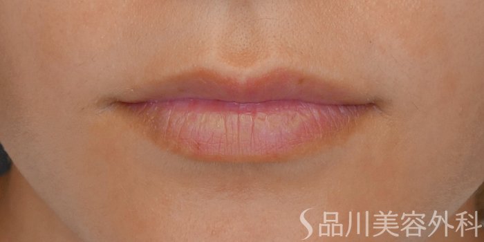 症例NO.71620のBEFORE写真
