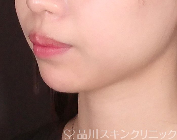 症例NO.69977のAFTER写真
