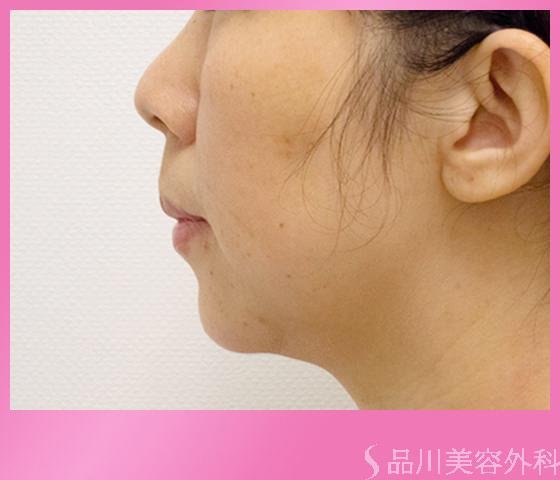 症例NO.21671のAFTER写真