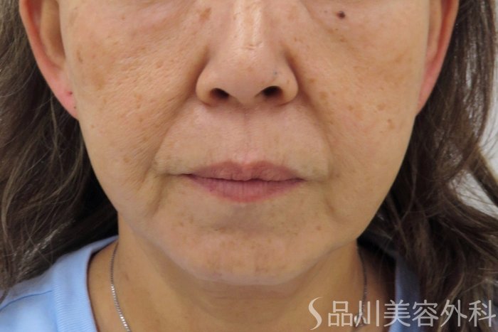 症例NO.74769のBEFORE写真