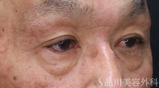 症例NO.69204のBEFORE写真
