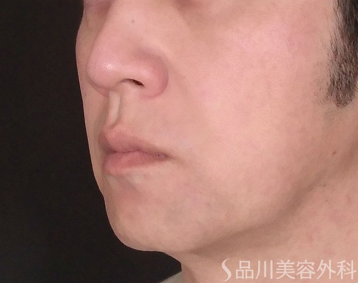 症例NO.72540のBEFORE写真