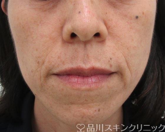 症例NO.30069のBEFORE写真