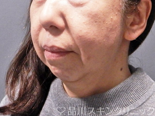 症例NO.63341のBEFORE写真