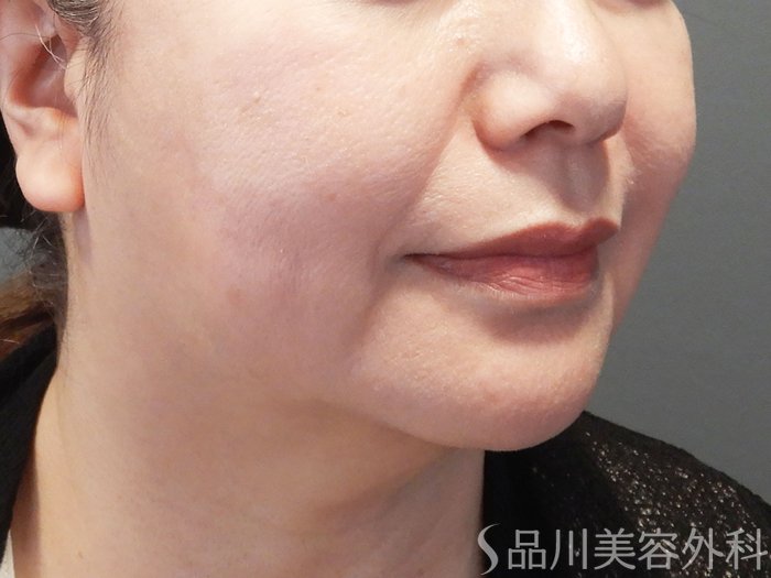 症例NO.74128のBEFORE写真