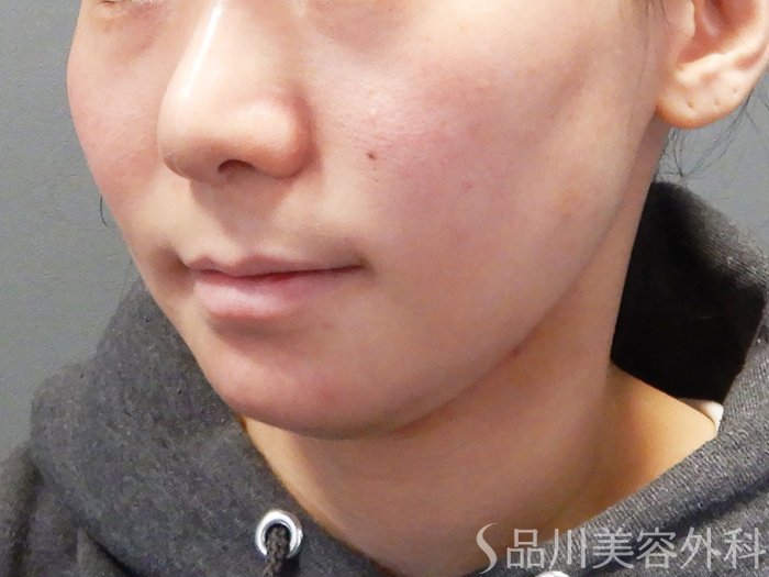 症例NO.74341のBEFORE写真