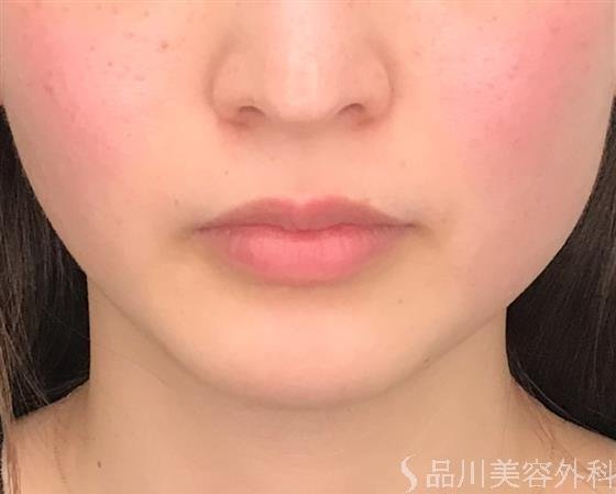 症例NO.54679のBEFORE写真