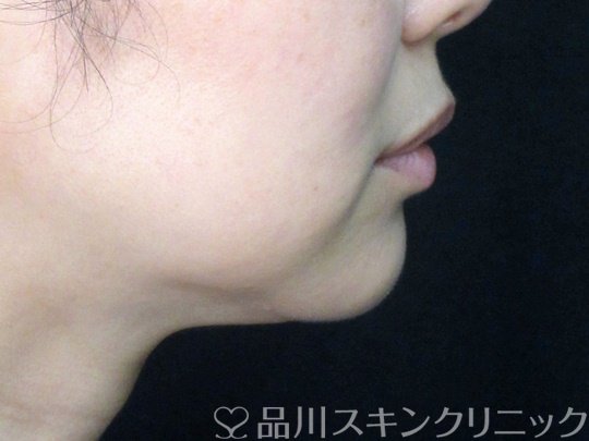 症例NO.70537のAFTER写真